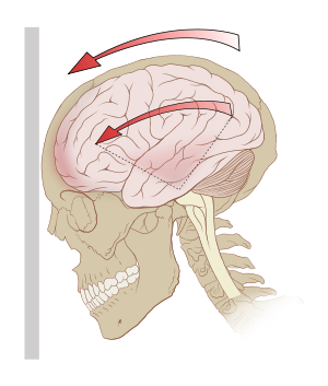 Everything You Must Know About Concussions